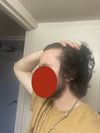 Experiencing Major Shed After Switching to Dutasteride and Moving Stress—Advice Needed