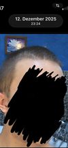 20M: Comparing Hair Density Over 2 Years - Is It Thinning?