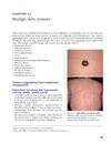 Benign Skin Tumors: Overview, Clinical Features, Histopathology, and Treatment Options