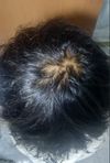 I need help, what&rsquo;s this baldness or a cowlick? My friends have been bothering me about this