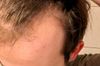 22M: Hair Loss Worsening Despite Using Prescribed Serum and Shampoo