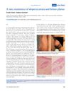 A Rare Coexistence of Alopecia Areata and Lichen Planus
