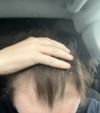 Just over 1 month Dutasteride 0.5mg + Minoxidil 2.5mg + Biotin 10mg