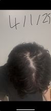 What is going on with my hair? Switched from fin(3 years) to Dutasteride 2-3 weeks ago. TE recovery, growth, or regrowth?