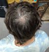 [M23] Finasteride journal