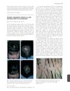 Iatrogenic Androgenetic Alopecia in a Male Phenotype 46XX True Hermaphrodite