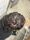 20M with Crown Thinning: Minoxidil/Finasteride Shedding Concerns