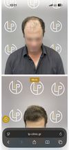 Seeking Opinions on Greek Hair Transplant Doctor Before Booking