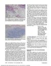 Dermal Mucinosis in the Eosinophilia-Myalgia Syndrome