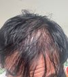 Seeking Advice on Persistent Thin Hair Post-Transplant at 30