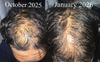 Progress Check: 3 Months on Dutasteride (0.5mg) + Minoxidil (2.5mg)