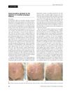 Acquired Trichomegaly of the Eyelashes and Hypertrichosis Induced by Bimatoprost