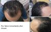 31M - Finally starting treatment after years of neglect. Need Help in reviewing my routine