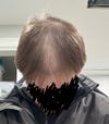 35M Considering Stopping Dut and Min Due to Side Effects After 9 Months