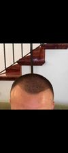 How many grafts do I need for a natural hairline and fuller temples? £3,800–£4,000 total budget