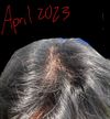 20M Using Minoxidil and Finasteride, No Improvement After 2 Years—Seeking Advice