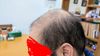 30-Year-Old Considering Hair Transplant After 2 Years of Treatment