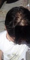 22M – Minoxidil didn’t work, bloodwork showed deficiencies, doctors dismissed me – not sure what to do next