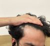 21M early hair loss — Fin only or Fin+Min? Anyone regret skipping minoxidil?