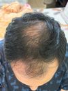 31-Year-Old Debating DUT Risks vs. Buzz Cut After Doctor&rsquo;s Advice