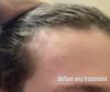 22M Experiencing Hairline Recession on Oral Fin After 18 Months - Advice?
