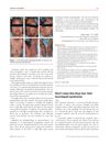 Don't Miss This Blue Toe: Hair Tourniquet Syndrome
