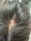 Early thinning – finasteride 2 weeks in, should I add minoxidil or switch to dut?