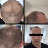 Evaluating Hair Regrowth Possibilities After Long-Term Hair Loss