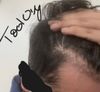18M: Persistent Hair Loss at Temples Despite Minoxidil/Finasteride, Adjust Dosage?