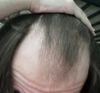18M: Thinning and Hair Loss at Temples - Advice Needed