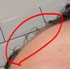 Should I Postpone My Hair Transplant to See If Fin/Min Works?