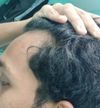 23M Receeding hairline, Hair fall and Hair thinning - Feeling mentally drained