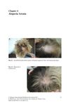 Alopecia Areata in a 45-Year-Old Female with Autoimmune Diseases