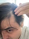 21M on Finasteride &amp; Topical Minoxidil: Is My Frontal Thinning AGA or TE?