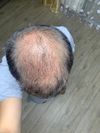 I had 4 DHI hair transplants from 2021 -2025. The last one was on August 15th. Why isn&rsquo;t my hair thickening? I&rsquo;ve tried all kinds of pills, including finsteride minoxodil, and why isn&rsquo;t anything working
