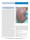 Fatal Toxic Epidermal Necrolysis Associated With Cetuximab in a Patient With Colon Cancer