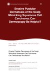 Erosive Pustular Dermatosis of the Scalp Mimicking Squamous Cell Carcinoma: Can Dermoscopy Be Helpful?