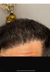 Transplanted hairs thinning after 3 years — oral minoxidil making things worse?