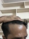 26M, NW 1, 64 days and no progress yet.57 days Redensyl and 7 days minoxidil