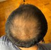 Struggling with Hair Regrowth Post-Transplant and Medication Restart