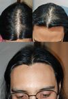 M32: Can Minoxidil Alone Work Without Finasteride for My Hair Loss?
