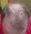 My Experience with Saw Palmetto, Minoxidil, and Side Effects at 32