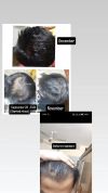 19M: 60% Hair Loss, Considering Finasteride After Minoxidil Success, Advice Needed