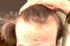 Should I Start Oral Minoxidil 2.5mg on Finasteride for Receding Temples?