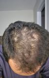 35M After 2.5 Years on Finasteride: Should I Consider a Transplant? Need Graft Estimates and Canada Options