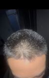 19M: Finasteride Not Helping Seb Derm and Hair Loss