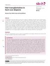 Hair Transplantation in Burn Scar Alopecia