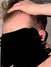 22-Year-Old Seeking Advice on Future Hair Transplant and Grafts
