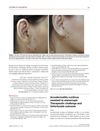 Acrodermatitis Continua Resistant to Etanercept: Therapeutic Challenge and Unfortunate Outcome