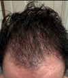 8 Months on Dutasreride and Hair Loss Progressively Worse